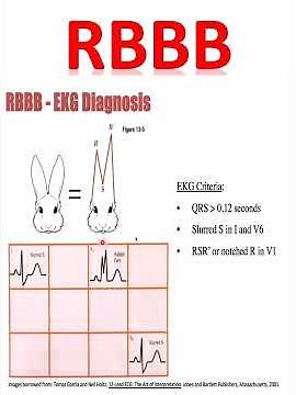 RBBB|Right bundle branch block|ECG interpretation #ecg