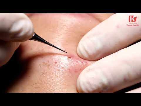 Extreme Blackhead Removal: Satisfying Pimple Popping Compilation! 🤯🔥