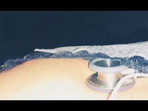 very visible heart murmur and arrhythmia~