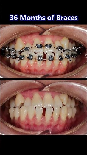 Amazing braces: Fix crooked and overbite teeth, 36 months duration #braces #orthodontist #dentist