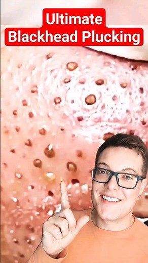 Crazy BLACKHEAD PLUCKING (pt2) - Painstaking Blackhead Removal #shorts