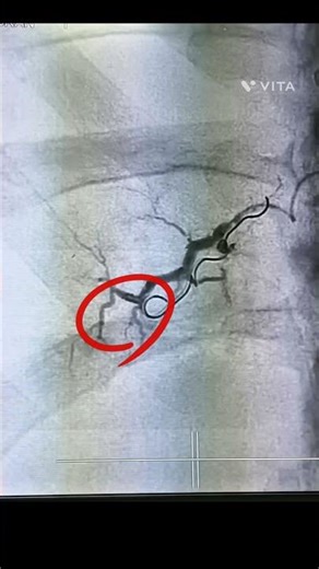 📌 Bleeding From TIPS – Coil + Lipiodol Glue Embolization | Interventional Radiology#TIPS
