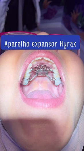 Aparelho Expansor Hyrax: Instalação e Ajustes Passo a Passo