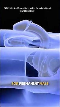 Vasectomy Surgery Explained in 3D Animation |Safe & Simple Procedure #shorts #shortvideo #shortsfeed