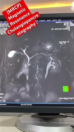 MRCP | Magnetic Resonance Cholangiopancreatography | #shortsfeed