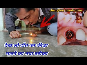 देख लो दांत का कीड़ा खत्म करने का नया तरीका/Teeth pain relief remedy