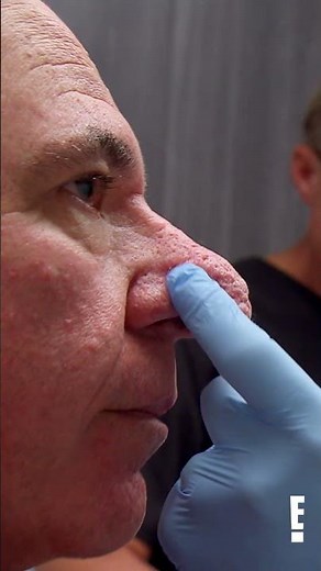 Andy's nose is completely collapsed on BOTH sides! #botched