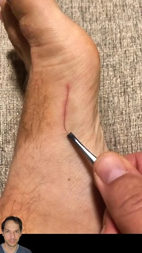 These can be really painful! Just ask any barber or pet groomer. 👉 Have you ever had a hair splinter? If so, let me know about it in the comments. 📰 Also, comment NEWSLETTER for more similar health information combined with a touch of humor, and I'll send you a link to my free weekly newsletter. #hair #hairsplinter #barber #petgroomer | Nick Pappas, MD