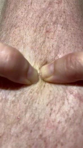 #pimplepopping #pimplepopper #blackheadremoval #satisfyingvideos #grossbutgood #extractions