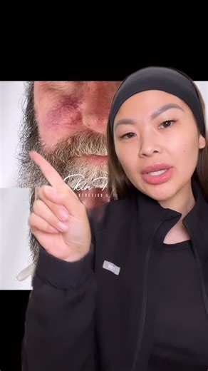 NURSE RACHEL | 90210 & OC Injector on Instagram: "✨ Say goodbye to those tiny red veins and “why won’t this go away” spots ✌🏻❤️ Meet Vasculaze — our go-to laser for clearing spider veins, broken capillaries, rosacea, and vascular lesions on the face and legs 💥 No numbing. No downtime. Just fast, precise energy that targets only the vein — leaving your skin clearer, smoother, & instantly more confident. ⚡️It’s safe. It’s quick. It works. Most patients start seeing results after just 1–3 session