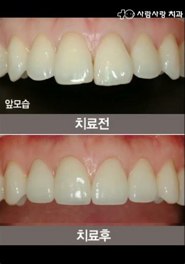 토끼이빨, 튀어나온 앞니 치료
