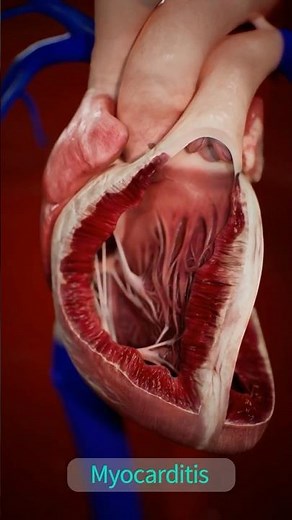Comparing Healthy Heart vs. Myocarditis 🫀 | Complete Anatomy