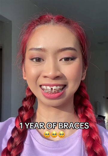 At the first stage of my journey, you saw me cried over this. My teeth issues were something that has weighed me down my whole life and it was a mentally challenging decision to get this done but I can’t believe I have officially passed one year since I did this. Throughout the year I felt something transformed in me. Both my mental and spirit. The bitterness and grudges I’ve held my whole life had been released. My teeth were not just a physical struggle, it was an inner turmoil too. I have alw