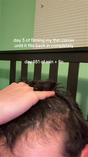 hair regrowth progress day 3 — minoxidil finasteride journey