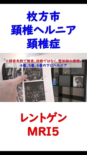 頚椎ヘルニアレントゲン・MRI5枚方市 #shorts #首のヘルニア #頸椎ヘルニア #頚椎ヘルニア #頸椎椎間板ヘルニア #頚椎症性神経根症 #頚椎症