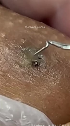 Effective Pimple Popping Techniques for Clear Skin