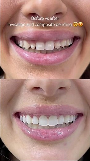Invisalign and composite bonding by Dr. Sonnie 🙌 #compositebonding