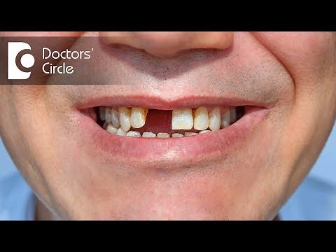 Is a Dental Bridge removable? - Dr. Mohammed Fayaz Pasha