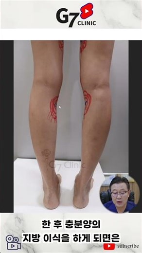 휜다리를 자가지방이식으로 해결할 수 있다는 충격적인 사실 #휜다리 #종아리 #종아리살빼기