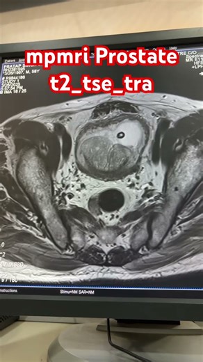 MRI Prostate (MPMRI) MultiParametic Magnetic Resonance Imaging #shorts