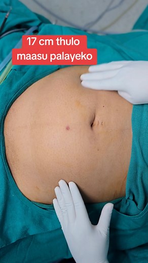 Understanding Laparoscopic Surgery Benefits in Gynecology