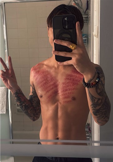 Traditional Cambodian Coining Treatment for Colds and Fevers