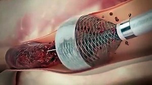 How to Remove Heart Blockage Without Surgery