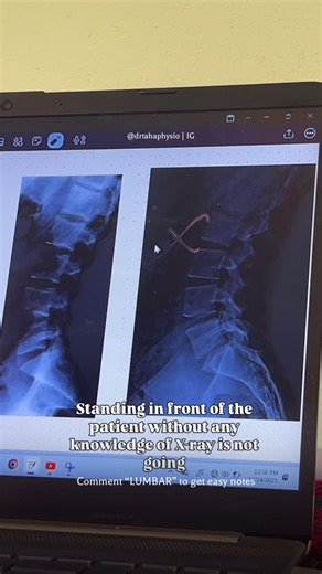 Dr Mohammed Taha (PT) | MPT (Musculoskeletal Science) on Instagram: "Comment “LUMBAR” i will DM you the chart Basic Lumbar Xray Interpretation by Dr Mohammed Taha(PT) Lumbar X-ray helps us understand what’s happening inside your lower back. It shows bone alignment, disc space changes, degeneration, fractures, and postural issues. Early diagnosis with clinical assessment = better treatment & faster relief ( physio, physiotherapist, physio dairies, physiotherapy, medico life. Medical college, medi