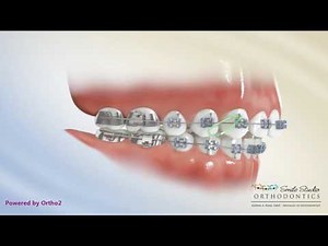 Elastics - Class II Triangle 3 to 4-5 - Orthodontic Treatment