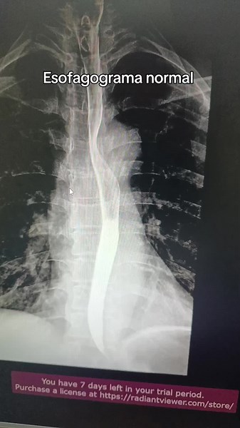 Esofagograma Normal: Importancia en Radiología