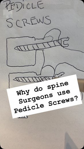 2.5K views · 135 reactions | Ever wonder why spine surgeons use pedicle screws? 領 They anchor directly into the strongest part of the vertebra — the pedicle — creating a solid foundation for spinal stability and fusion. Strength, precision, and safety all in one tiny piece of metal. Hashtags: #SpineSurgery #PedicleScrew #EndoscopicSpineSurgery #SpineHealth #Neurosurgery | Albert Telfeian | Facebook