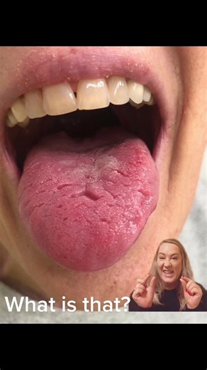 Understanding Fissured Tongue: How to Safely Scrape Your Tongue