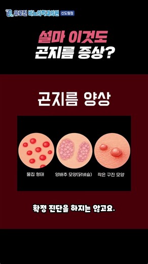 곤지름 증상, 이렇게도 나타난다 잠복기는 얼마나 될까