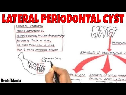 Lateral periodontal cyst - Pathogenesis, Clinical, Radiographic and Histopathologic features