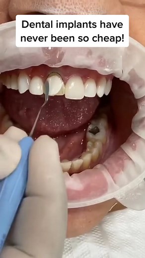 Cheap Dental Implants on TikTok