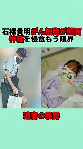 がん細胞が顔面神経を侵食する現状