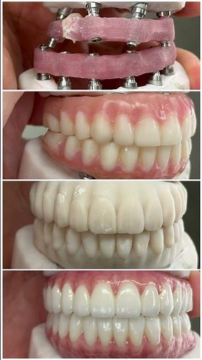 Process full mouth implant zirconia!