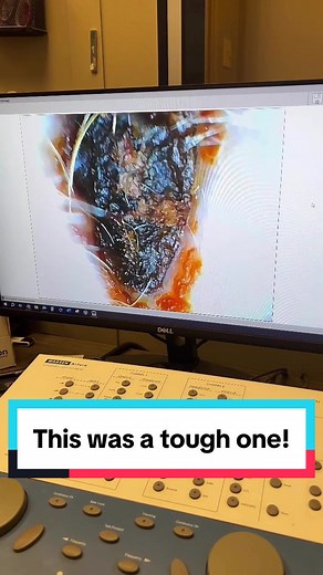 Effective Ear Irrigation for Stubborn Wax Removal