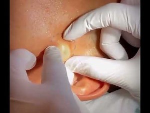 Ear Cyst Popper
