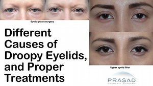 Different Causes for the Appearance of Droopy Eyelids, and Appropriate Treatments