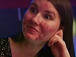 23-year-old woman with severe cystic acne embraces her skin