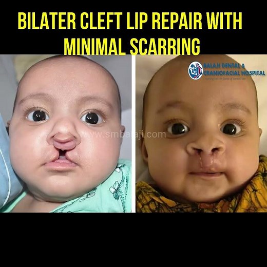 Bilateral Cleft Lip Repair with Minimal Scarring