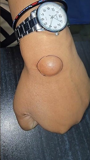 Ganglion cyst
