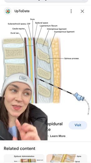 The epidural stays in your back?? Labour & delivery Nurse fact checks! All the information in this video is for informational purposes and cannot be taken as medical advice! Always consult your own health care providers! #greenscreen #epidural #newmom #pregnancy #firsttimemom #painreleif #labourandbirth #labouranddeliverynurse #labouranddelivery #newborn #anaesthesia #anaesthetic #hospitalbirth #medicatedbirth #unmedicatedlabor #baby | Nurse Sydney