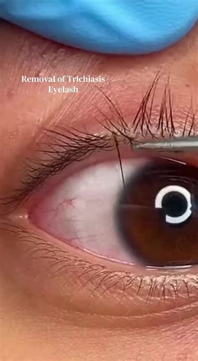 Removal of Trichiasis eyelash. This is a reenactment of a actual situation. #trichiasis #eyelash #foryoupage #drpimplepopper #eye
