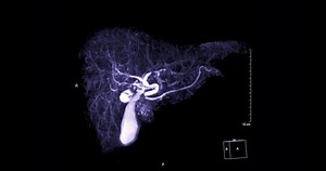 Magnetic resonance cholangiopancreatography or MRCP 3D MIP view showing visualize the biliary and pancreatic ducts .