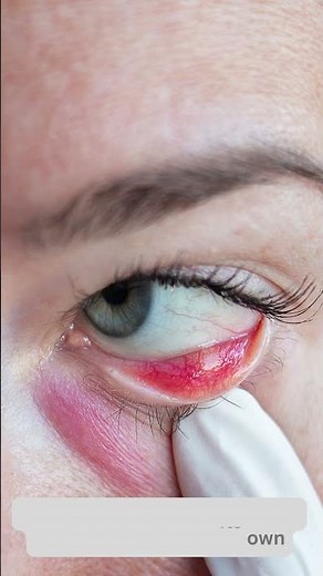 Discover Quick Relief: Dealing with a Stye - Expert Advice from Shyama Eye Hospital 👁️🌡️