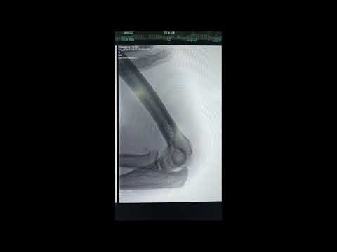 Elbow dislocation #reduction #conservative #plaster
