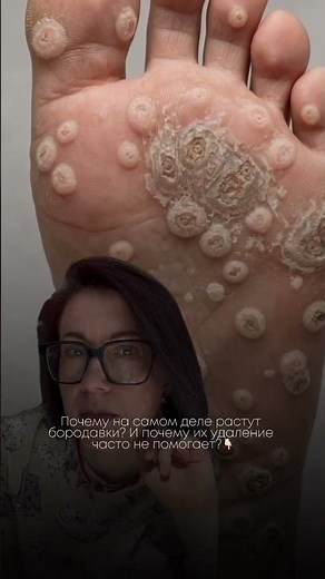Why Do Warts Grow and Why Is Removal Often Ineffective?