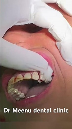 Localized gingival hyperplasia